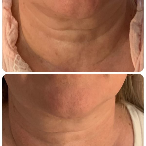 High Intensity Facial Ultrasound Before and After